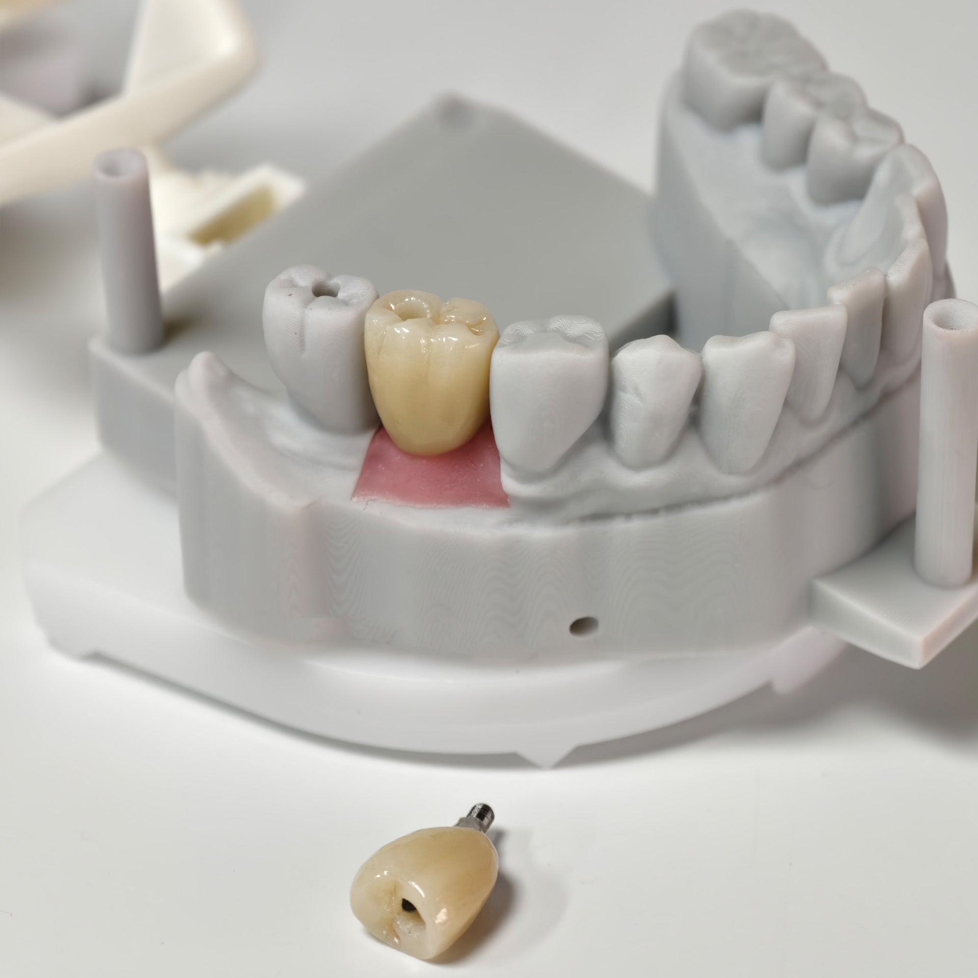 Zirconia Crowns With Screw Retained