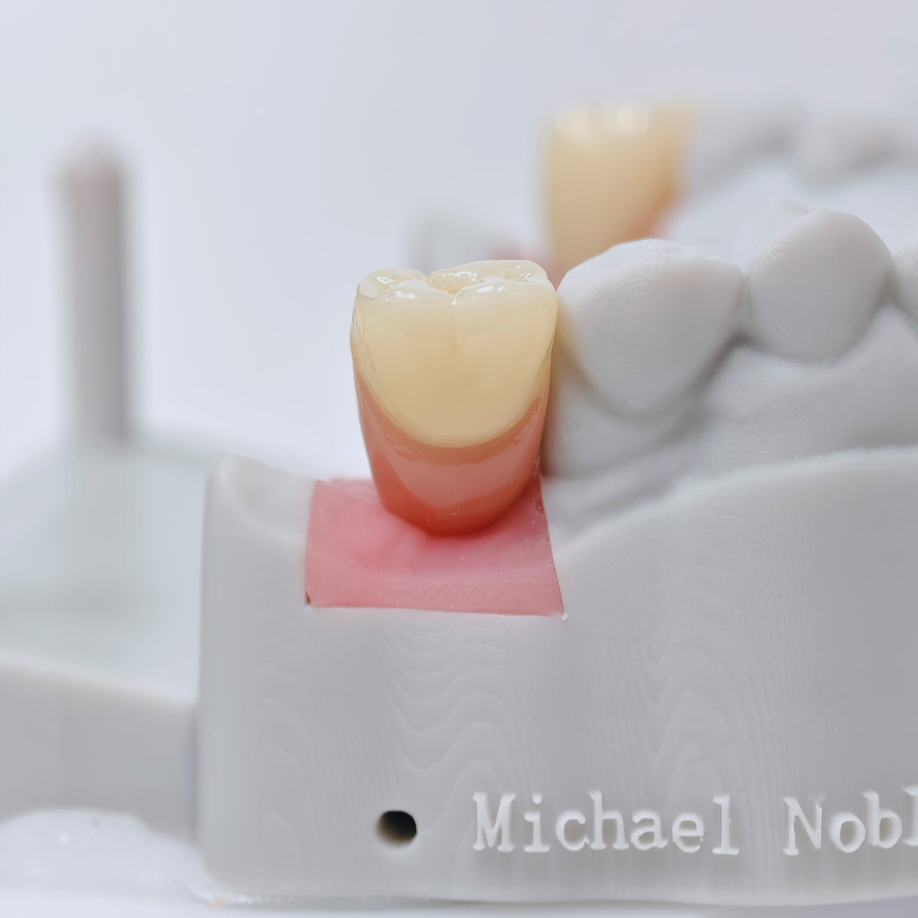 Zirconia Crowns With Screw Retained