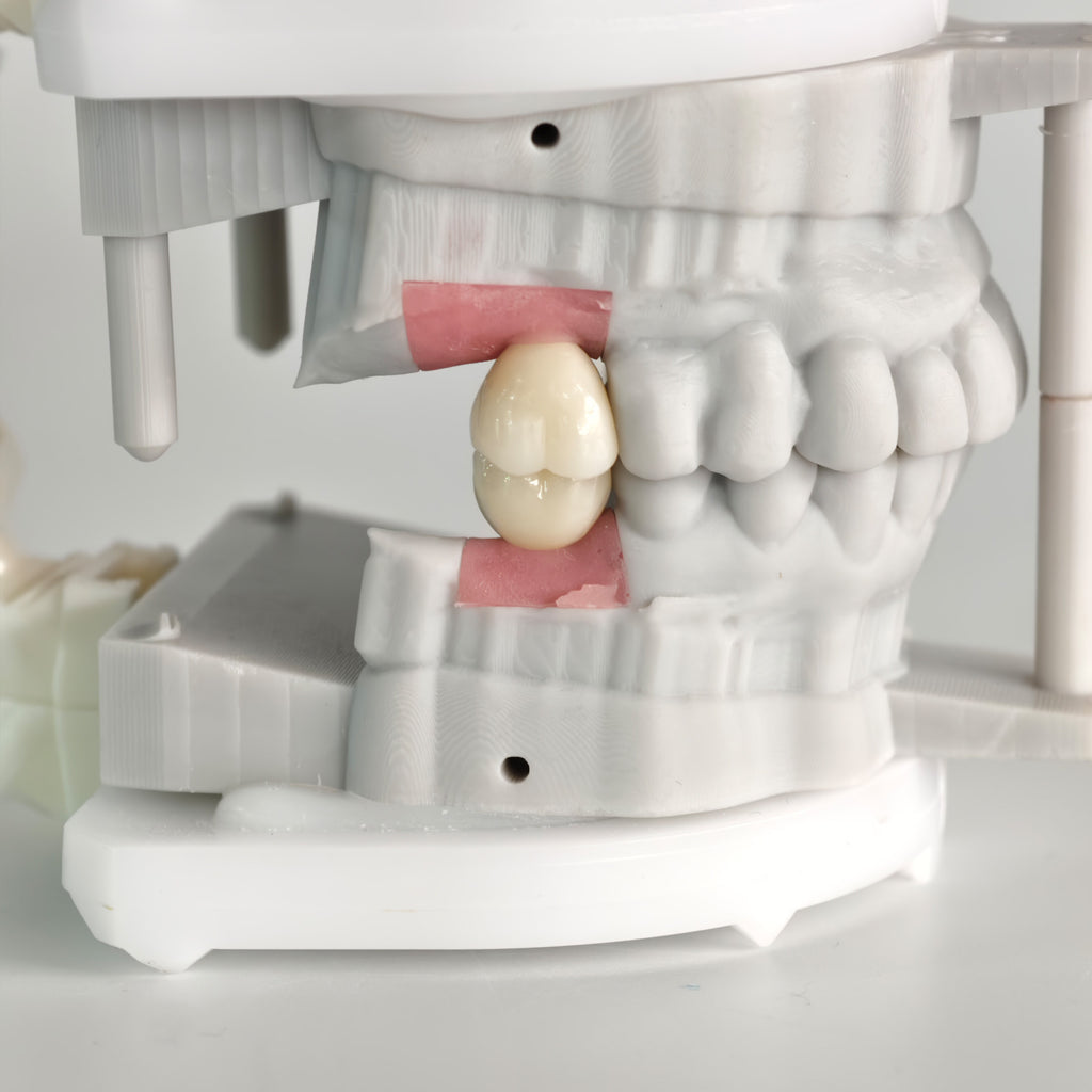 Zirconia Crowns With Screw Retained