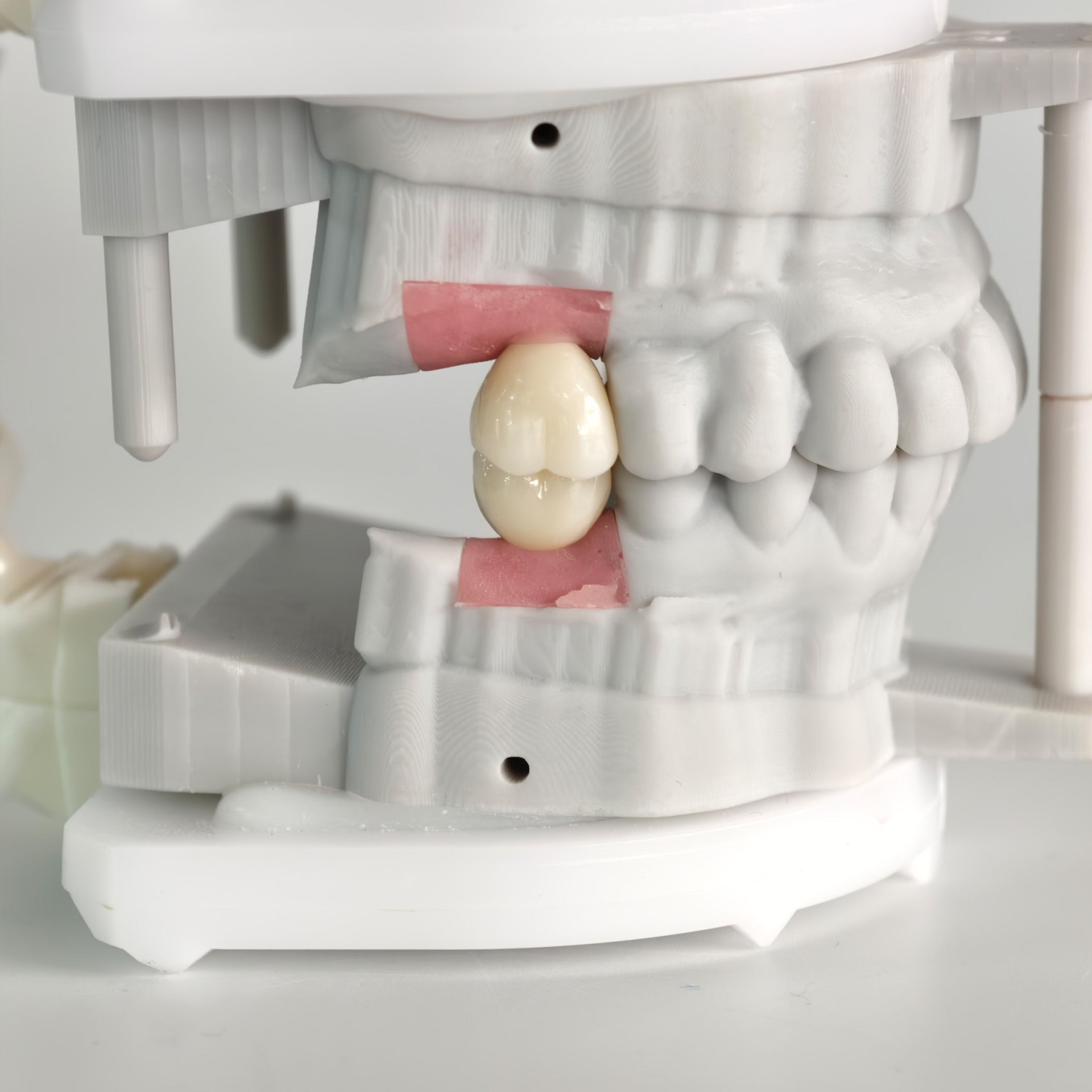 Zirconia Crowns With Screw Retained