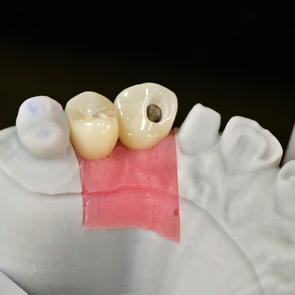 Zirconia Crowns With Screw Retained