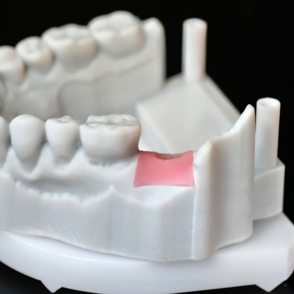 Zirconia Crowns With Screw Retained