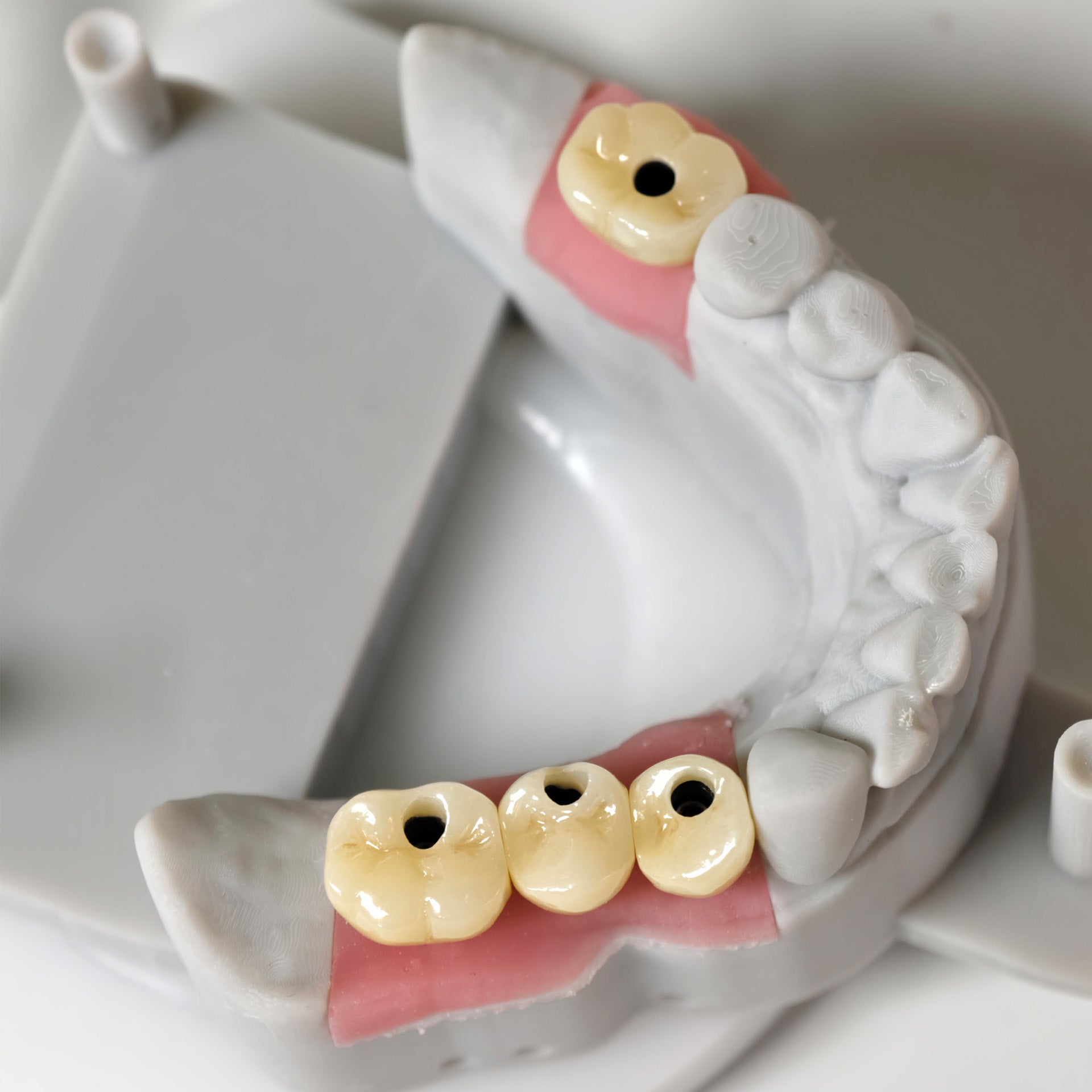 Zirconia Crowns With Screw Retained