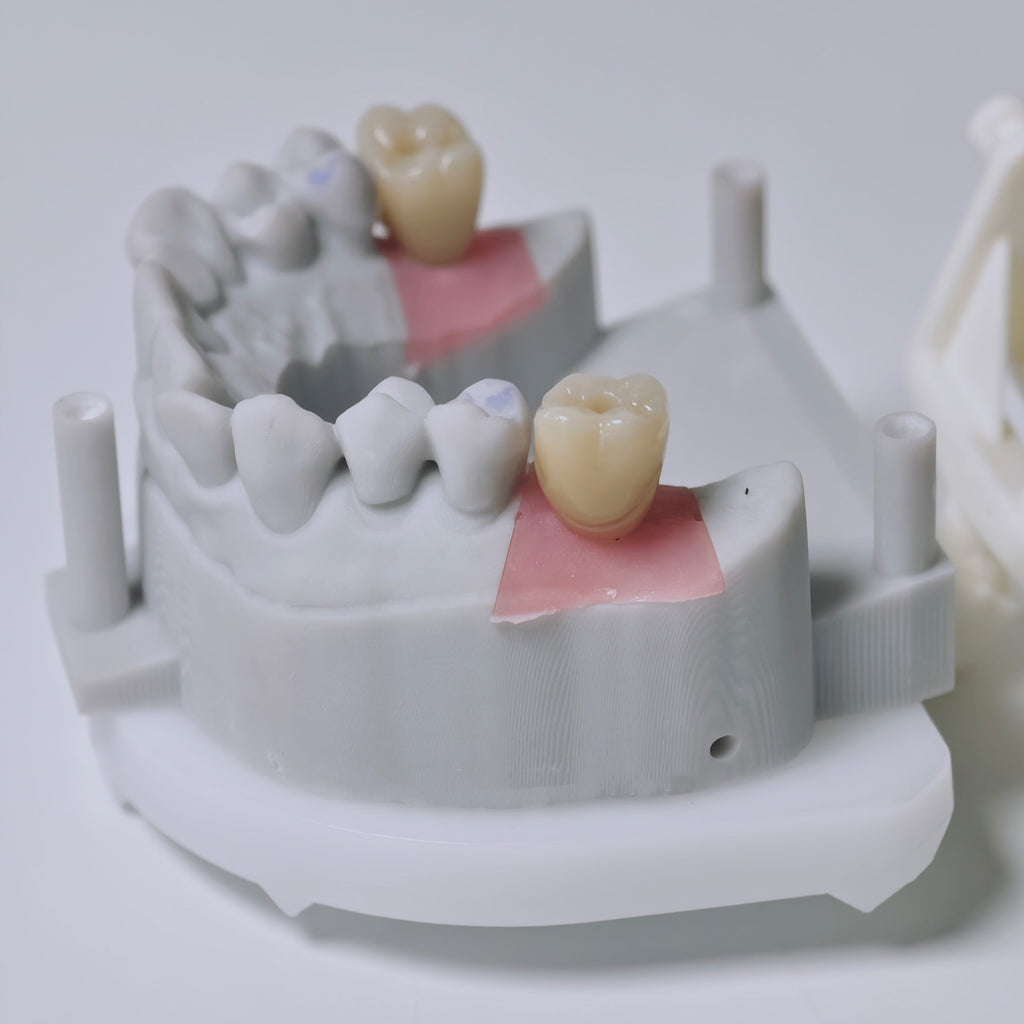 Zirconia Crowns With Screw Retained