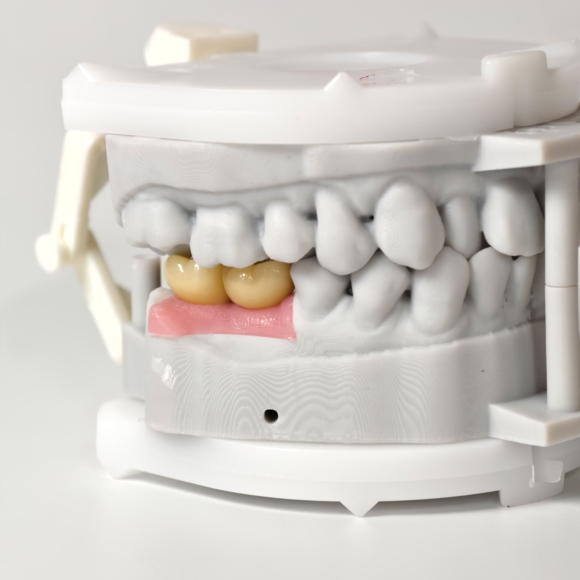 Zirconia Crowns With Screw Retained