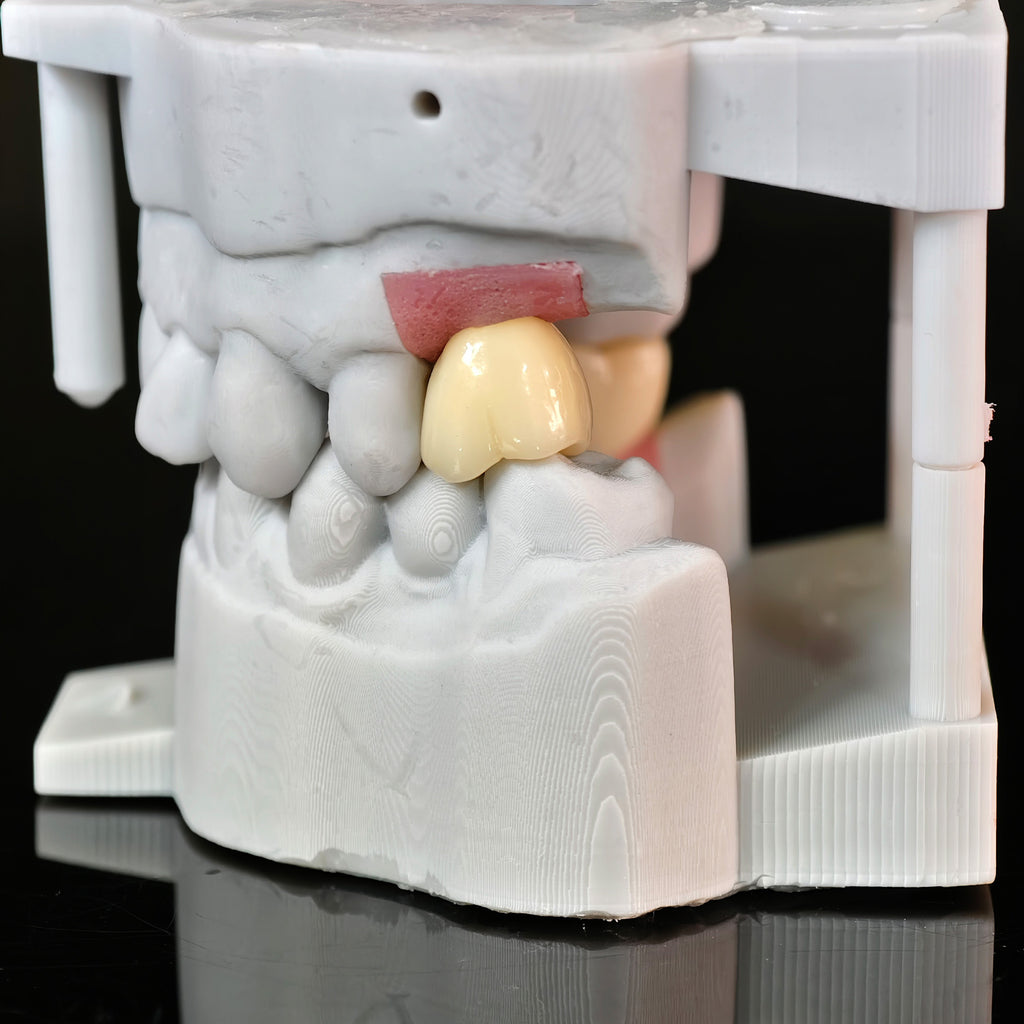 Zirconia Crowns With Screw Retained