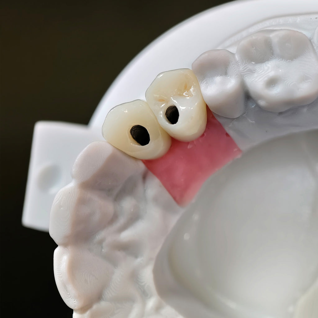 Zirconia Crowns With Screw Retained