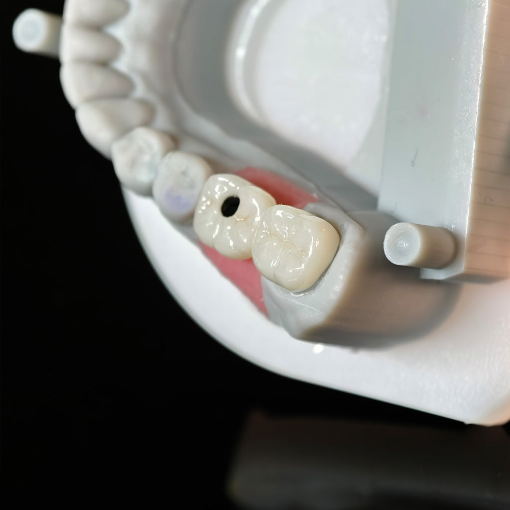 Zirconia Crowns With Screw Retained And Cement Retained