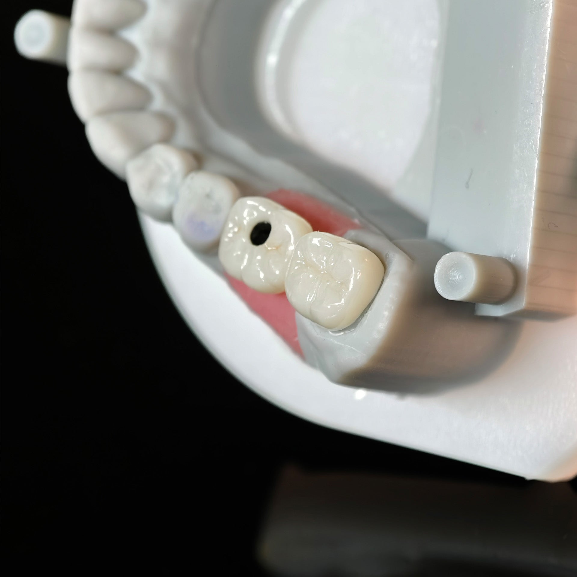 Zirconia Crowns With Screw Retained And Cement Retained