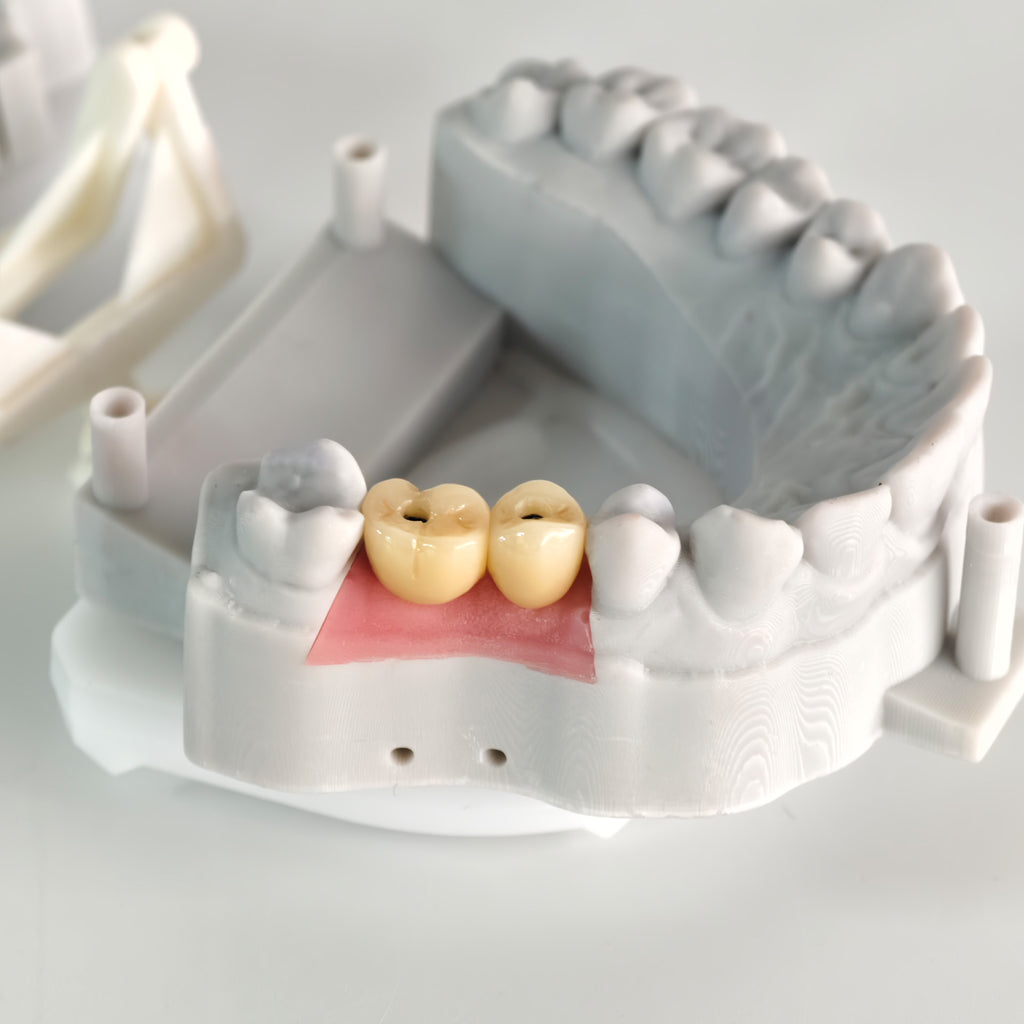 Zirconia Crowns With Screw Retained And Gold-Plated Custom Abutment
