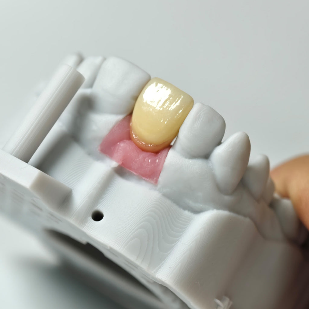 Zirconia Crown With Gold-Plated Abutment