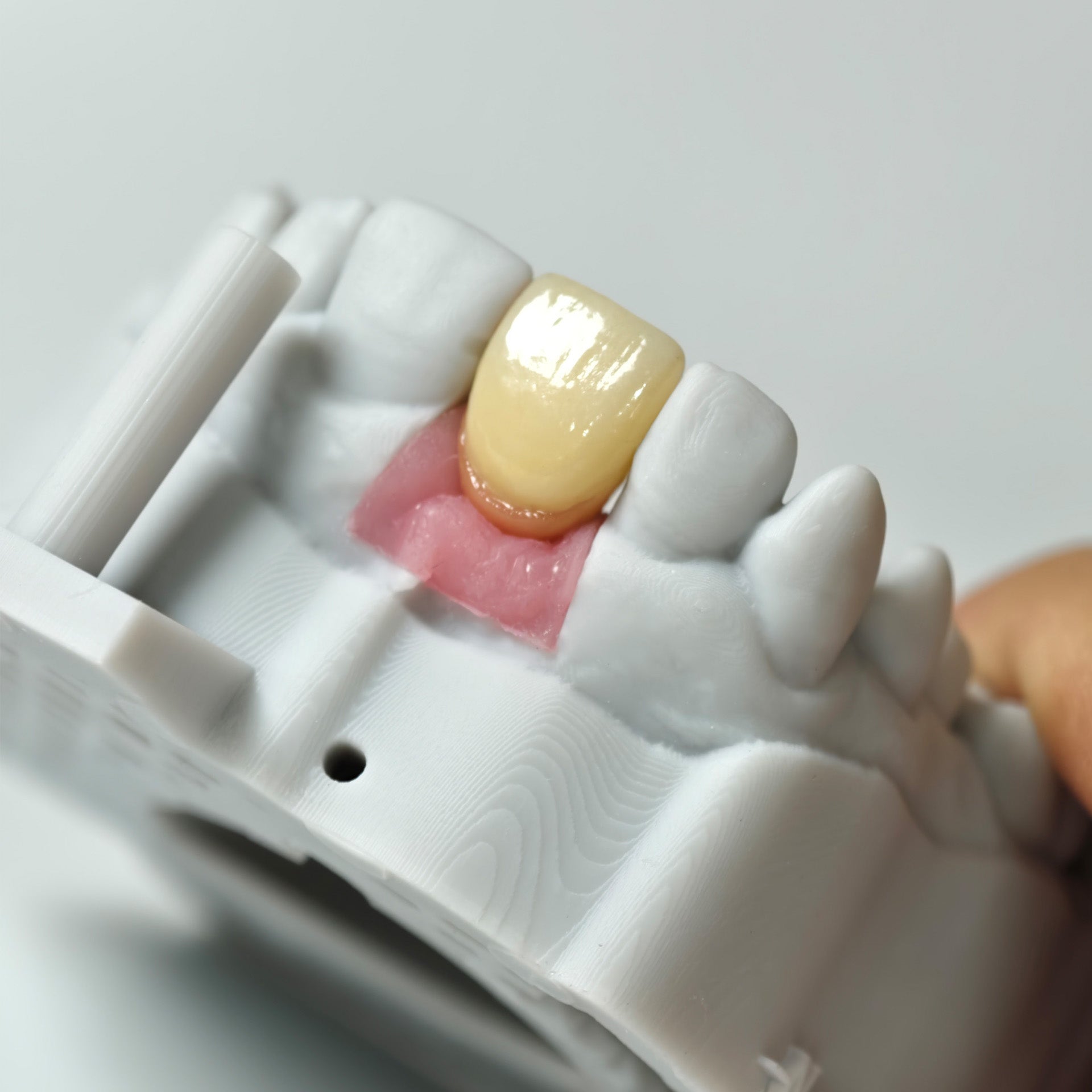Zirconia Crown With Gold-Plated Abutment