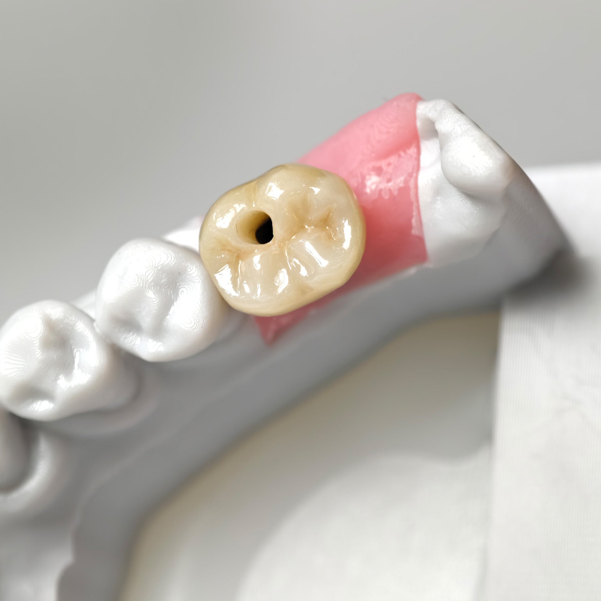 Zirconia Crown With Gold-Plated Abutment