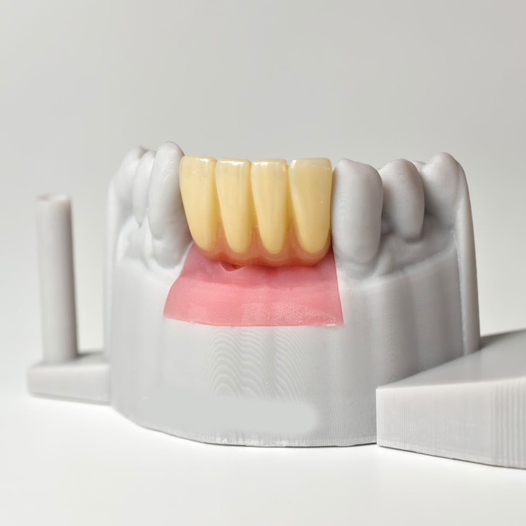 Zirconia Crown With Gold-Plated Abutment
