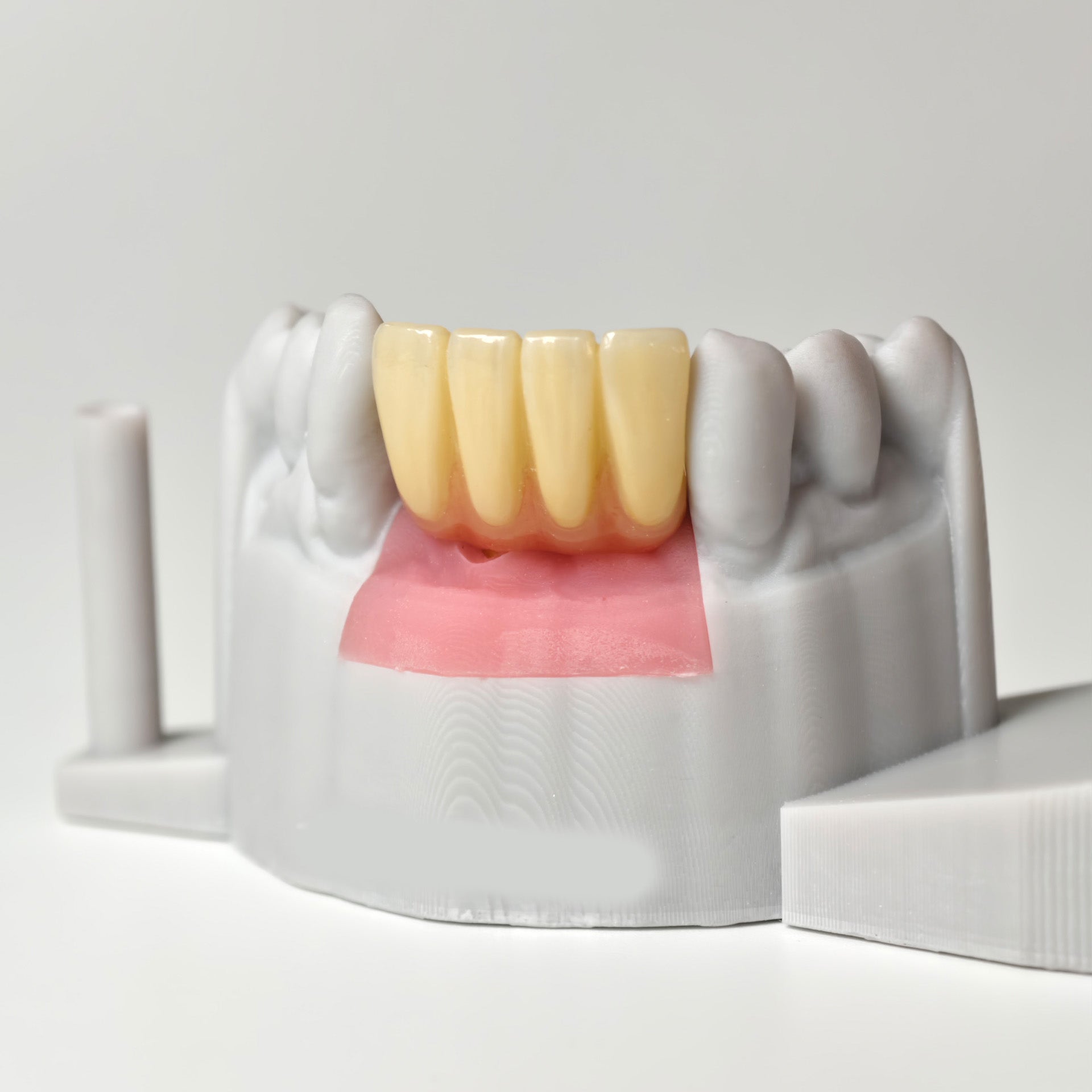 Zirconia Crown With Gold-Plated Abutment