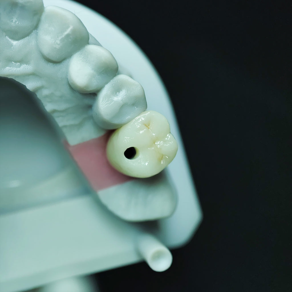 Zirconia Crown With Screw Retained