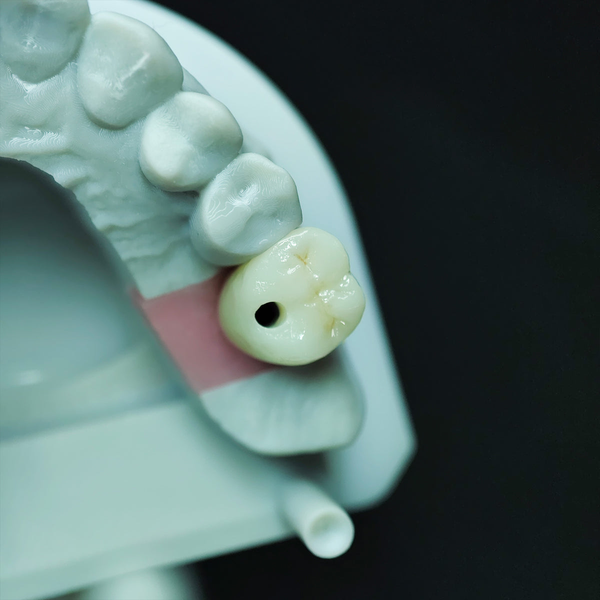 Zirconia Crown With Screw Retained