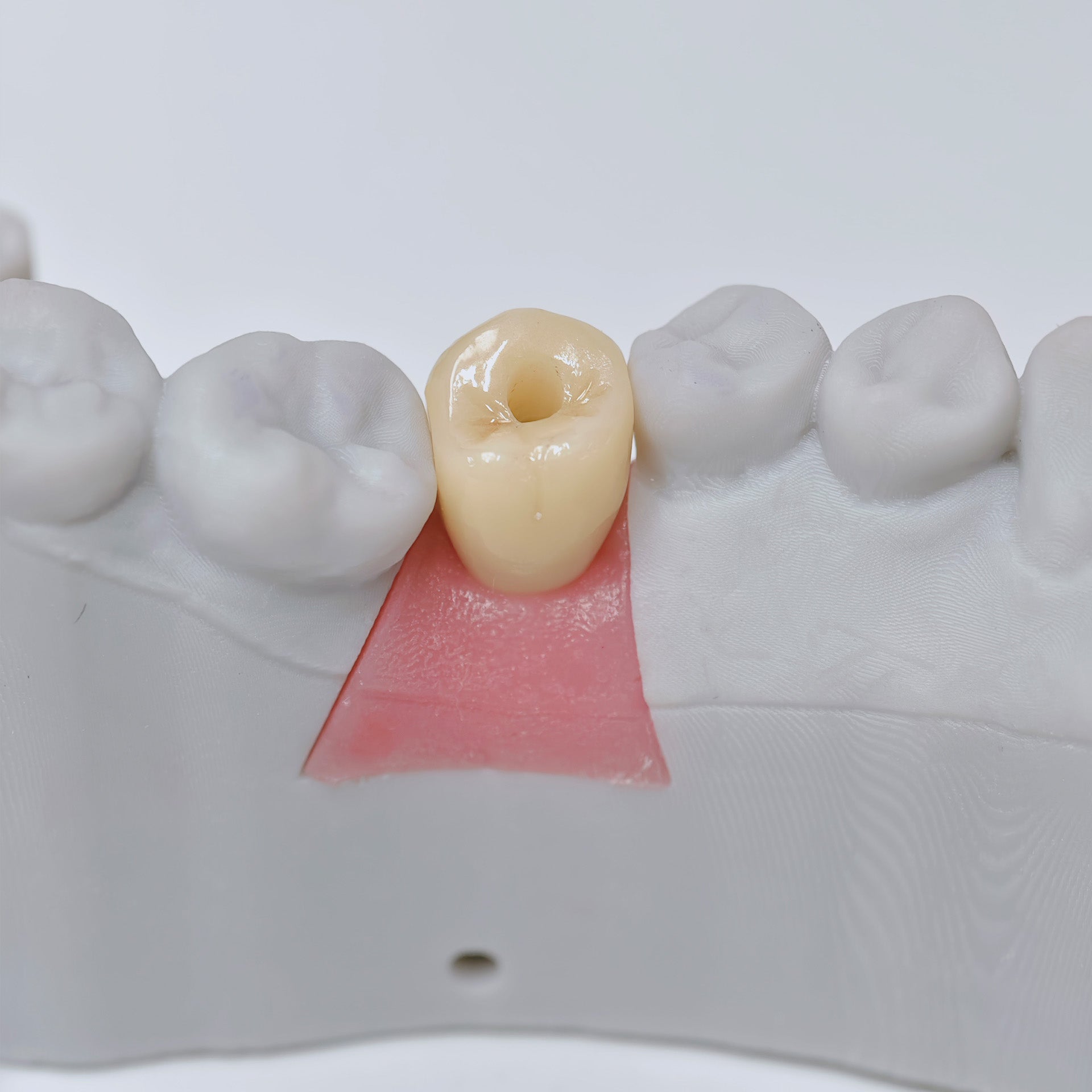 Zirconia Crown With Screw Retained