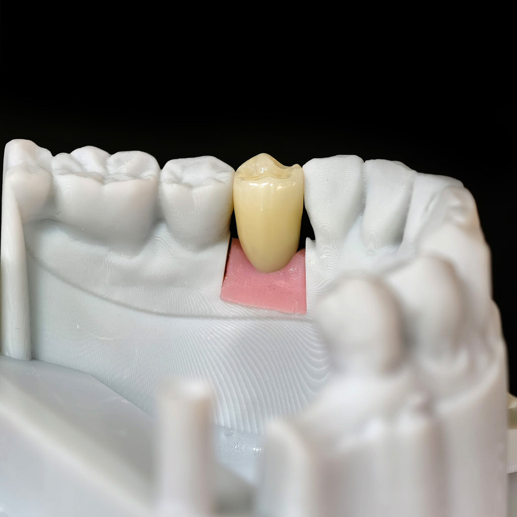 Zirconia Crown With Screw Retained
