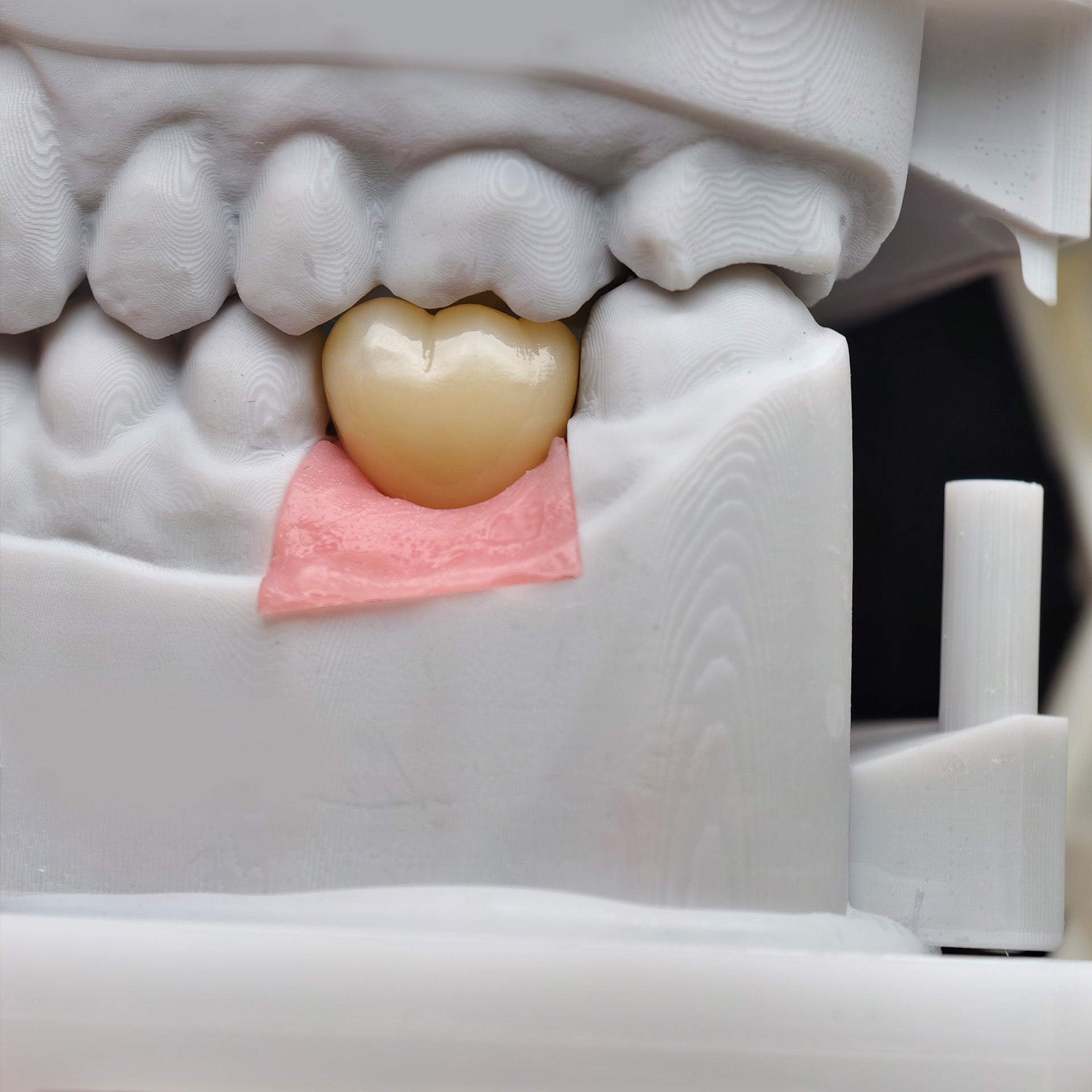Zirconia Crown With Screw Retained
