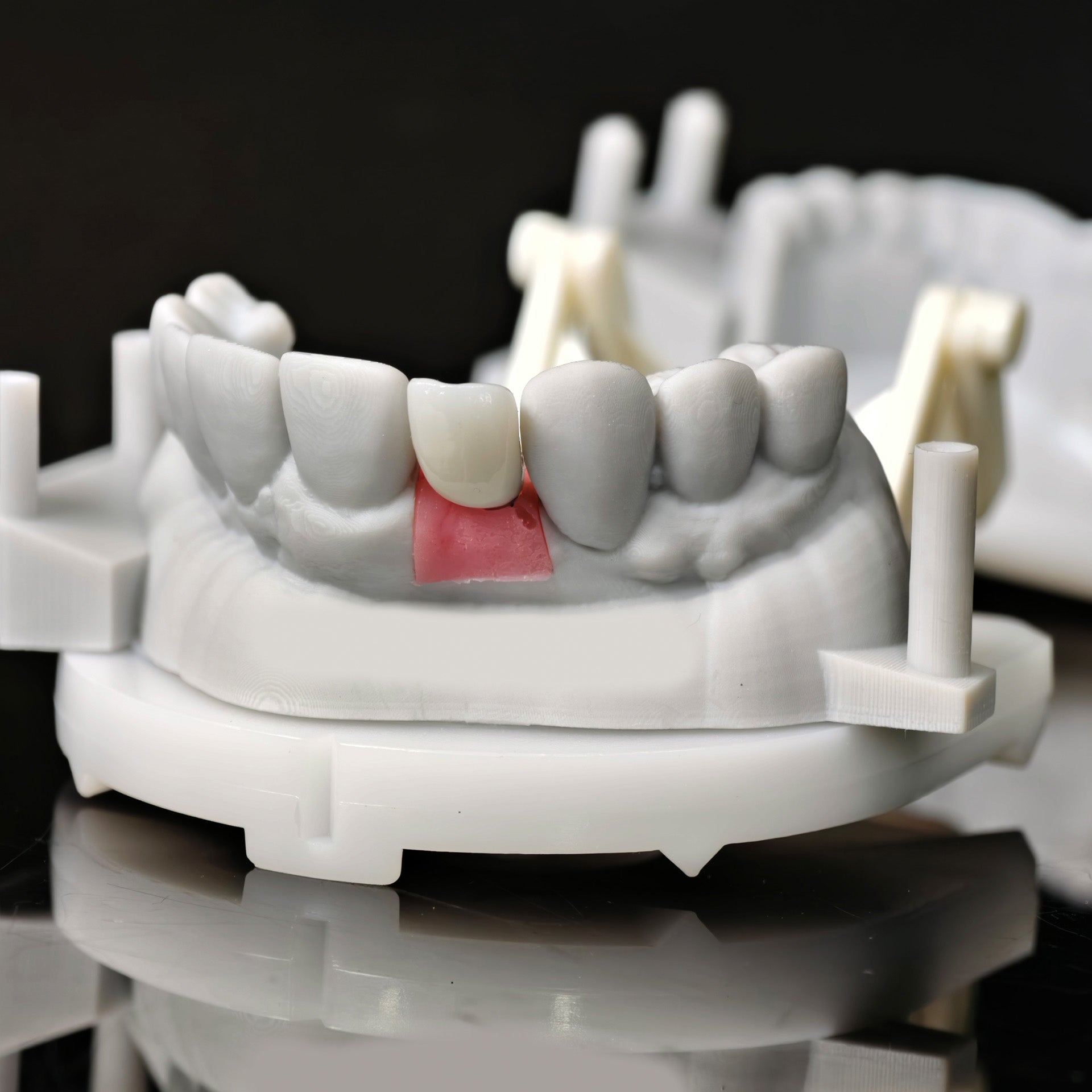Zirconia Crown With Screw Retained