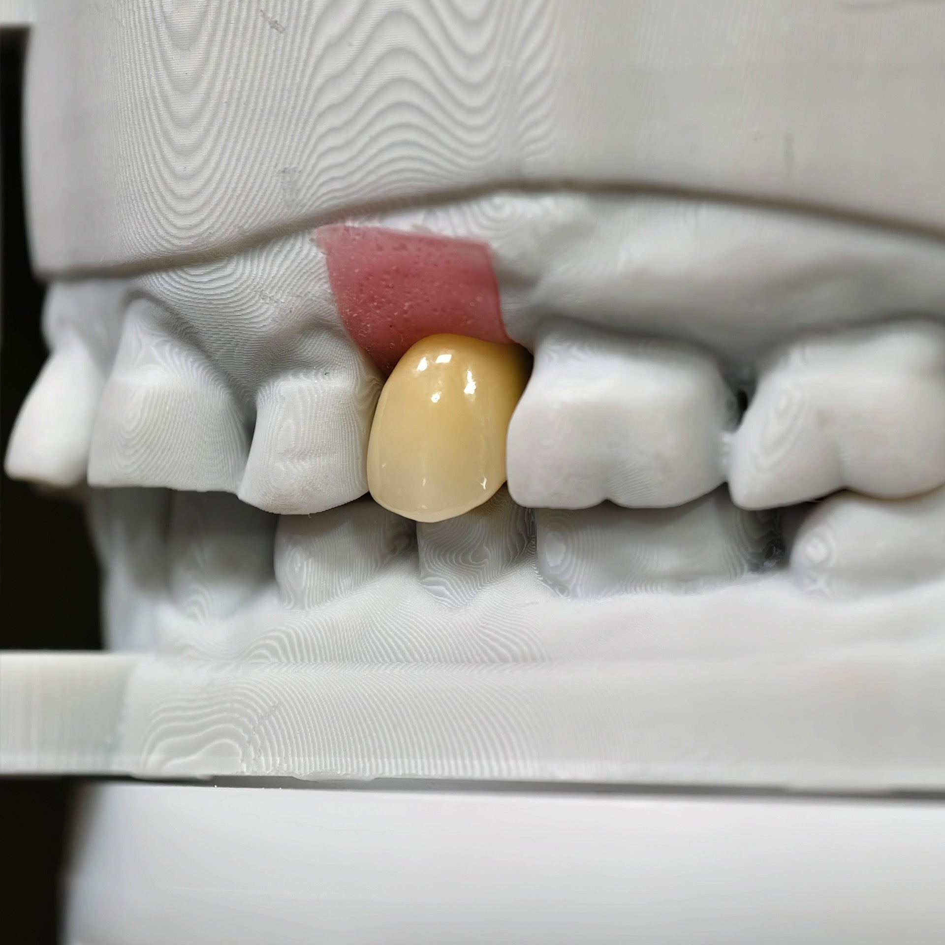 Zirconia Crown With Screw Retained