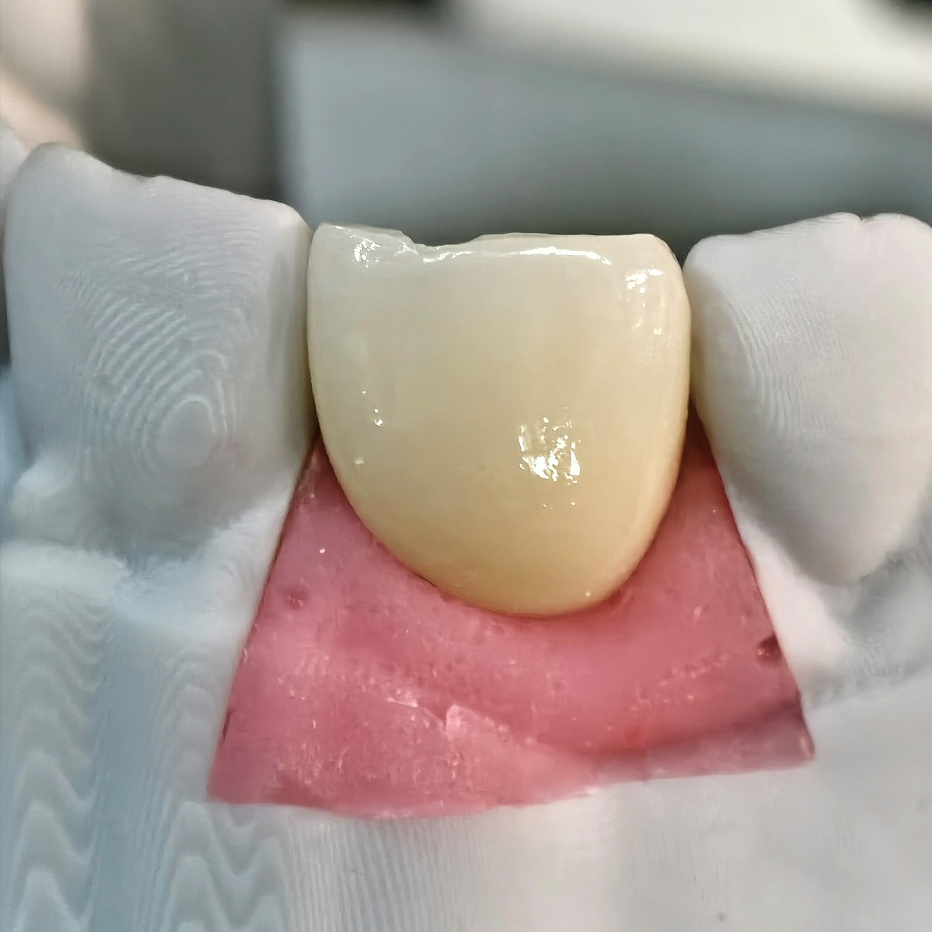 Zirconia Crown With Screw Retained