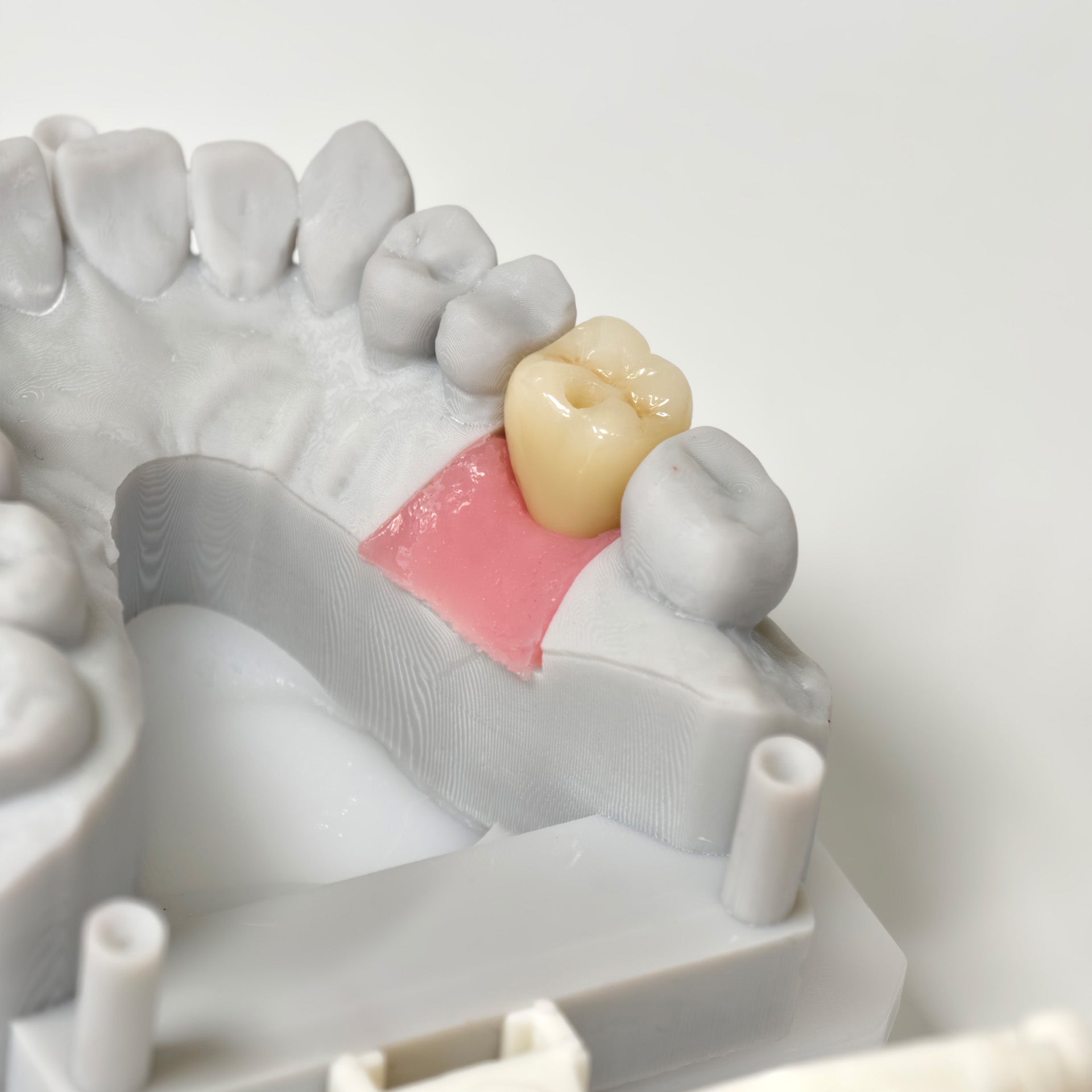 Zirconia Crown With Screw Retained