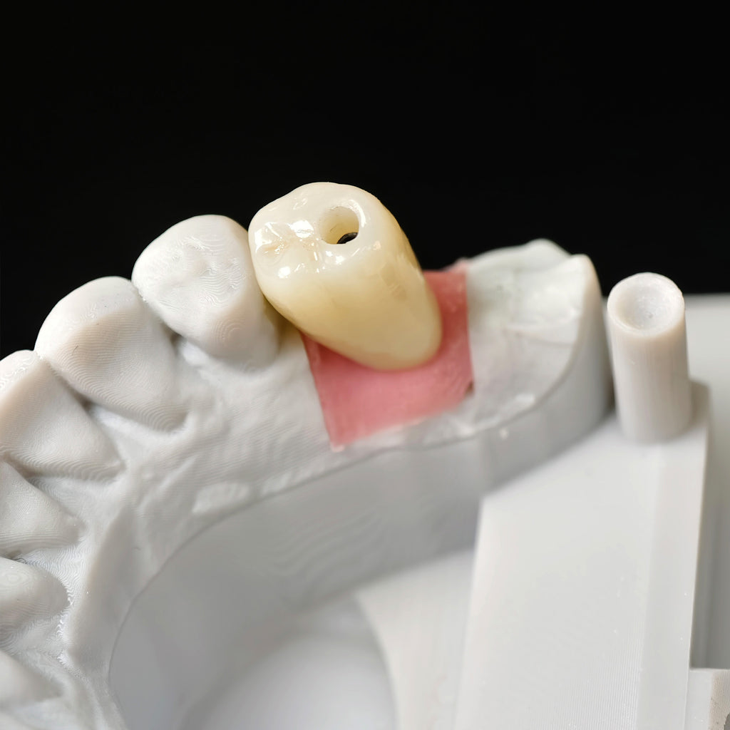 Zirconia Crown With Screw Retained