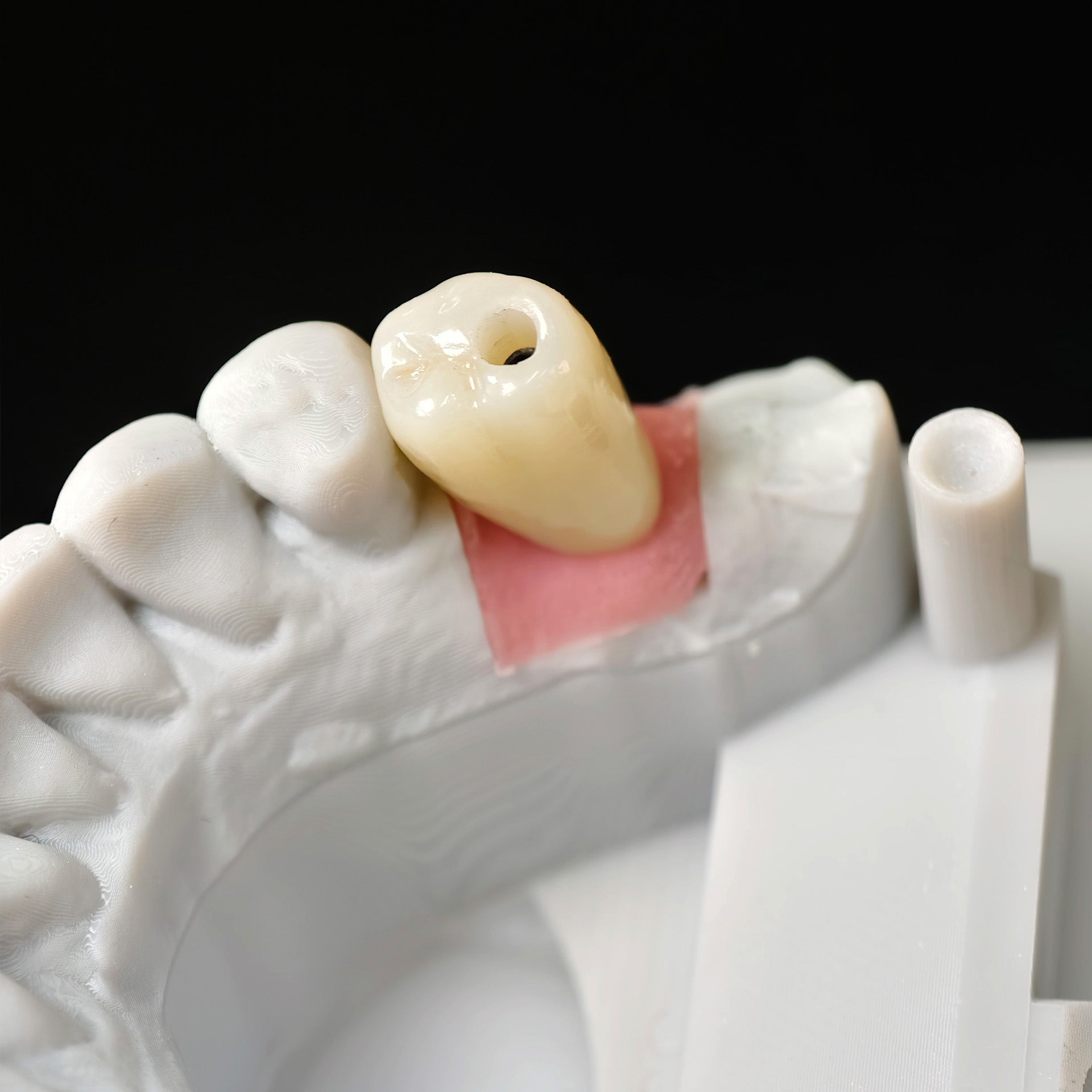 Zirconia Crown With Screw Retained