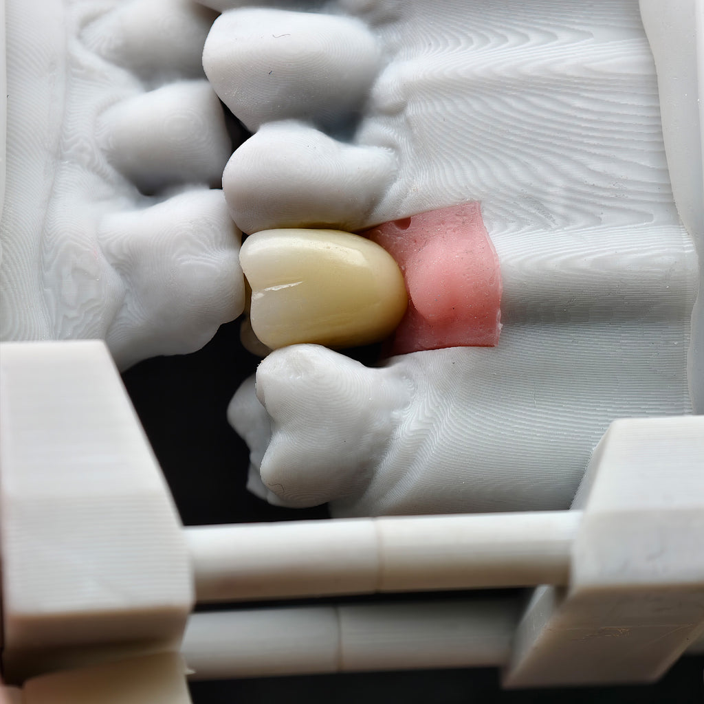 Zirconia Crown With Screw Retained