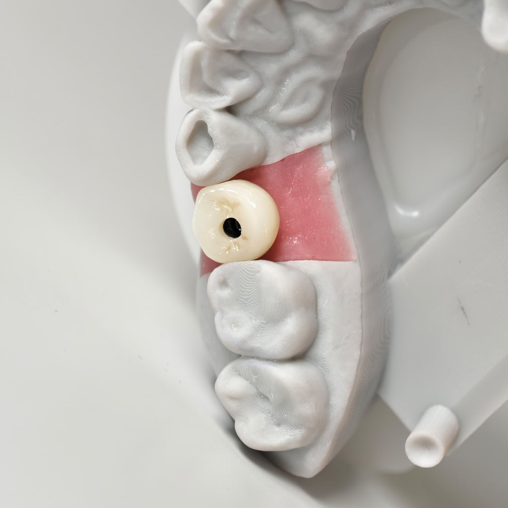 Zirconia Crown With Screw Retained