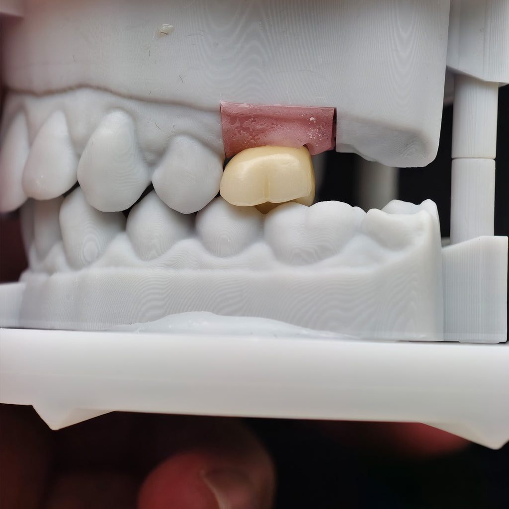 Zirconia Crown With Screw Retained