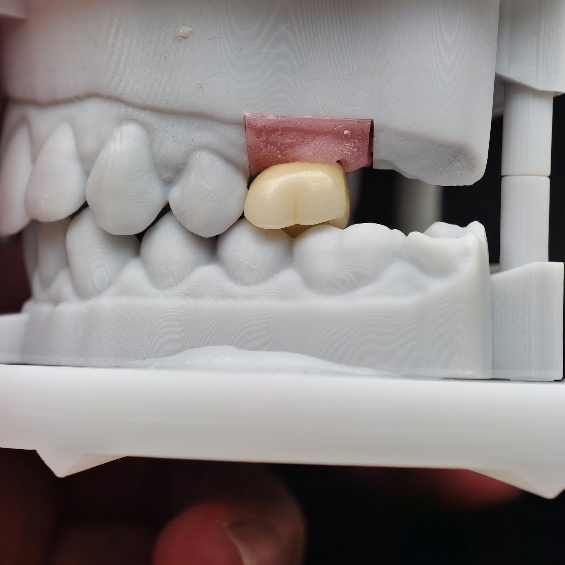Zirconia Crown With Screw Retained