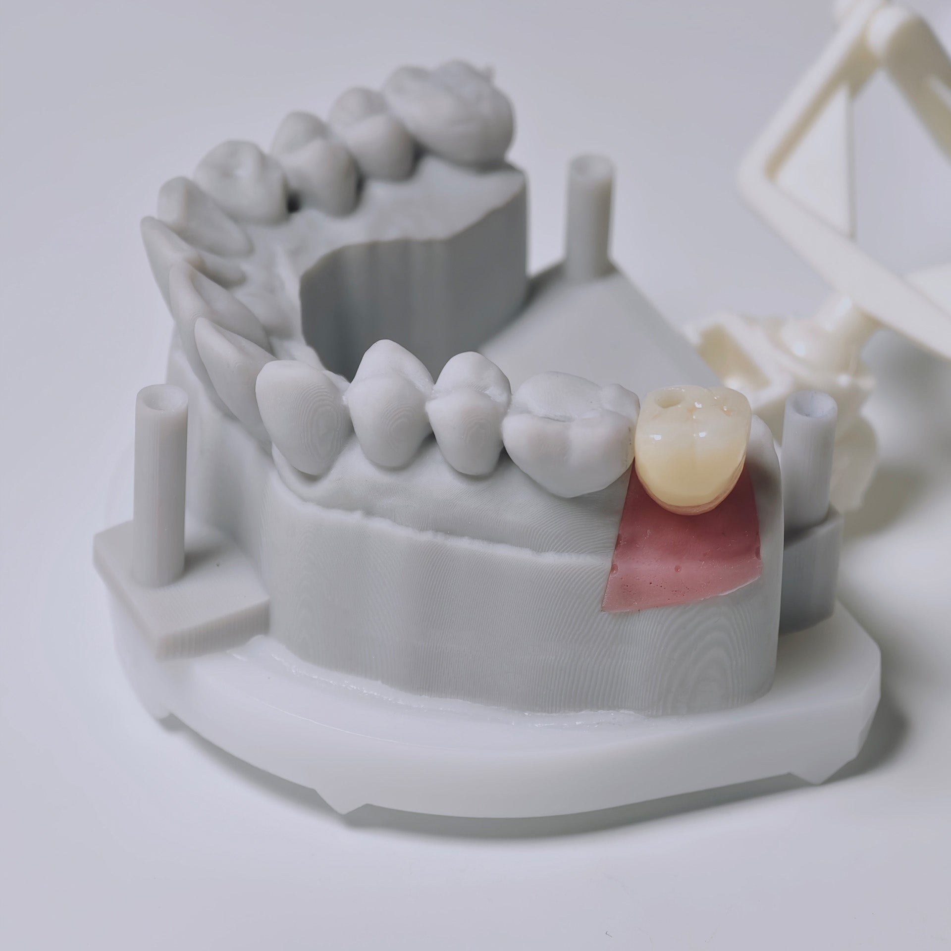 Zirconia Crown With Screw Retained