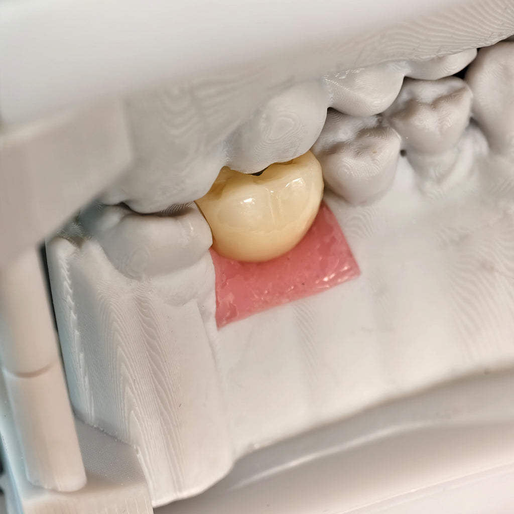 Zirconia Crown With Screw Retained