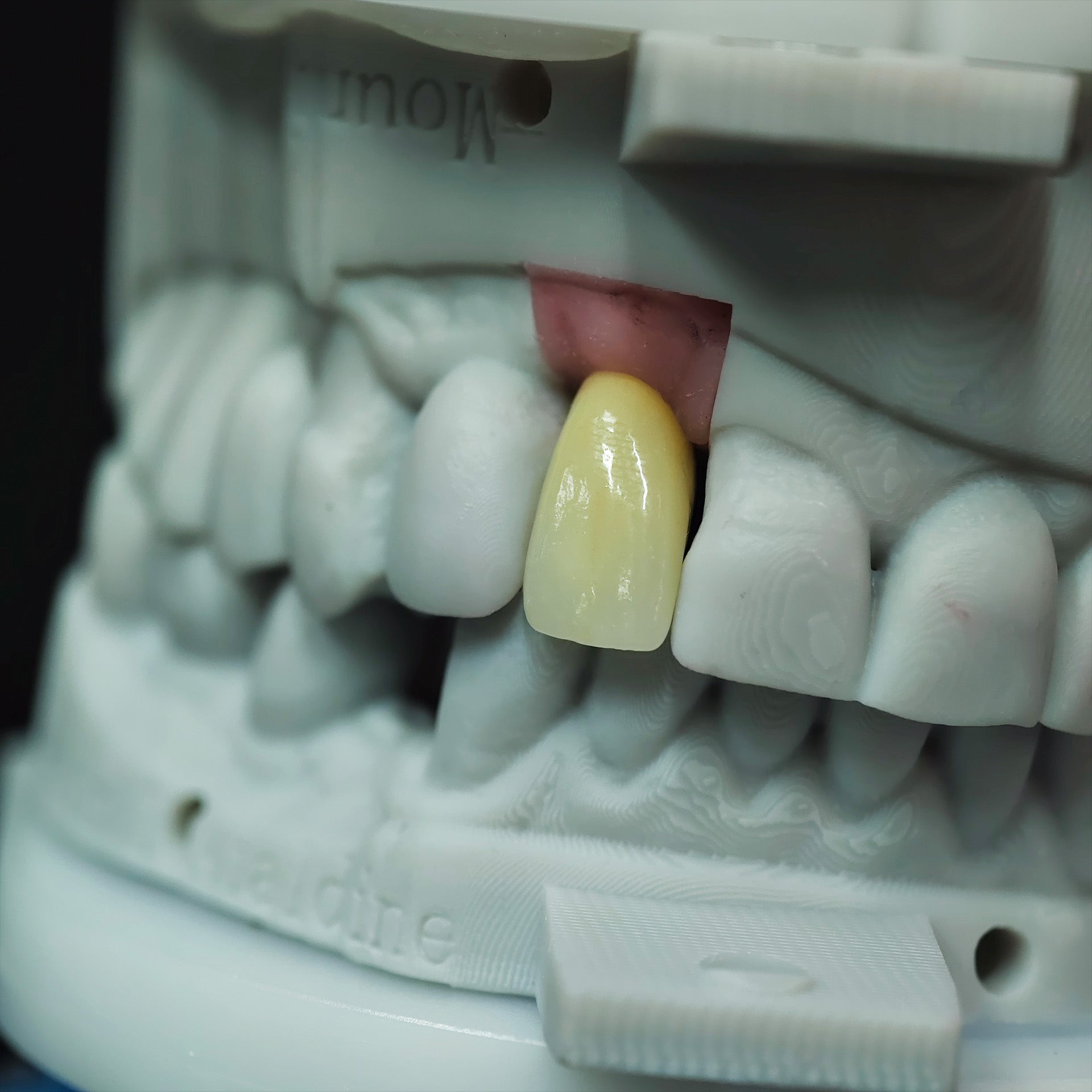 Zirconia Crown With Screw Retained