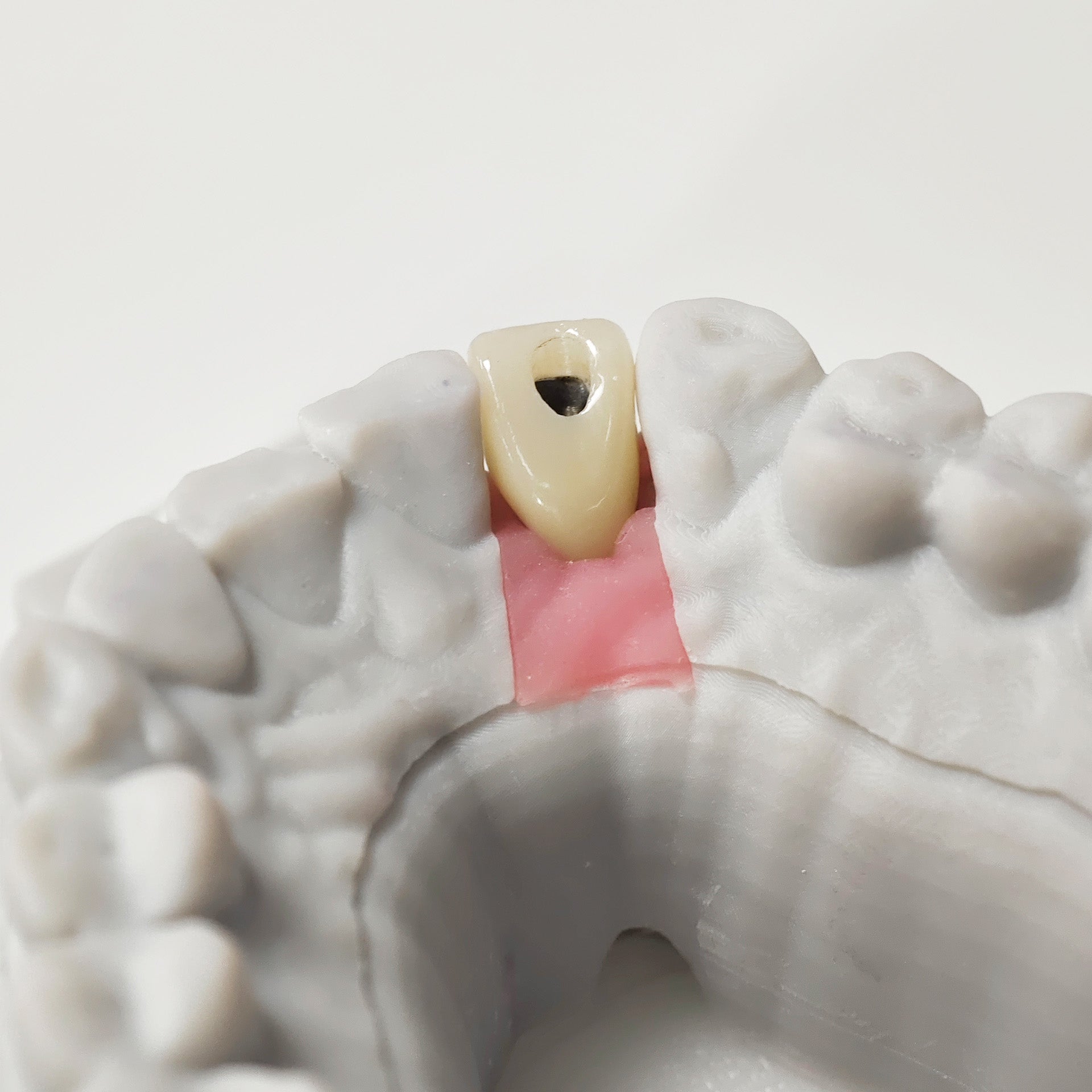Zirconia Crown With Screw Retained