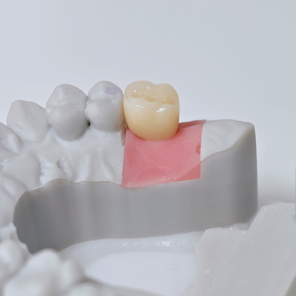 Zirconia Crown With Screw Retained