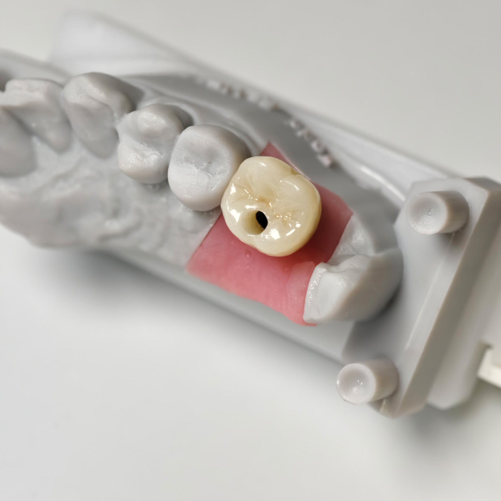 Zirconia Crown With Screw Retained