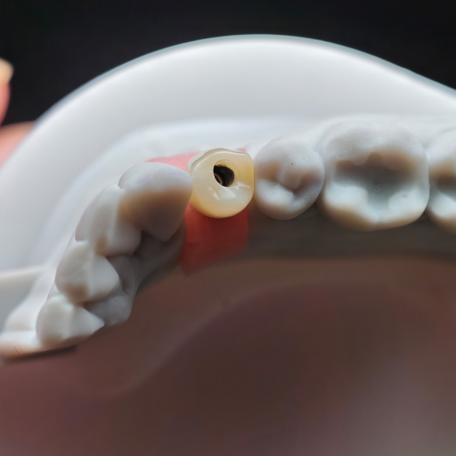 Zirconia Crown With Screw Retained
