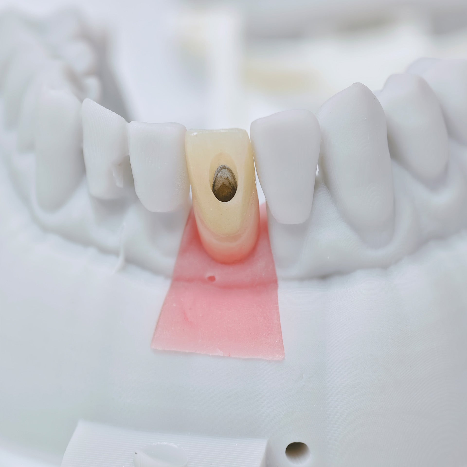 Zirconia Crown With Screw Retained