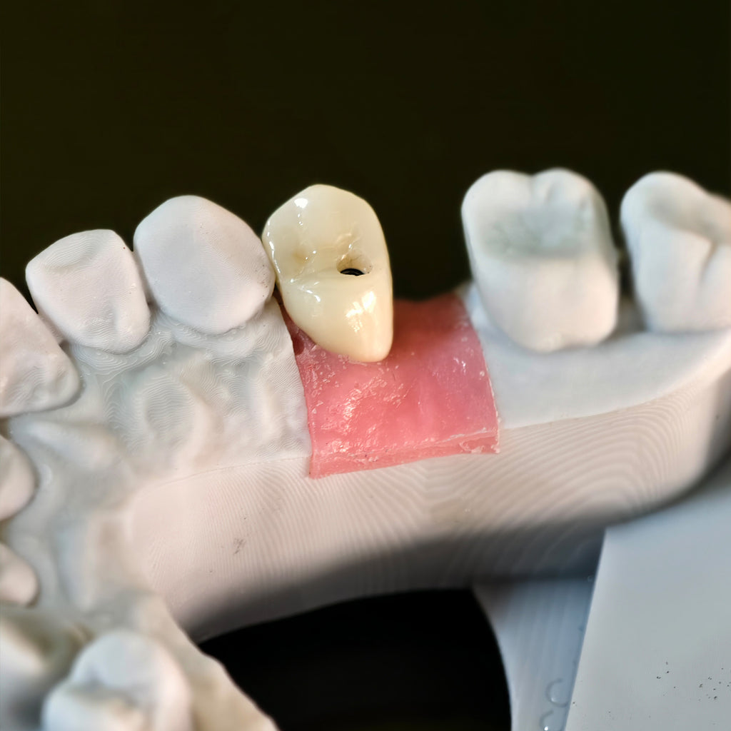 Zirconia Crown With Screw Retained