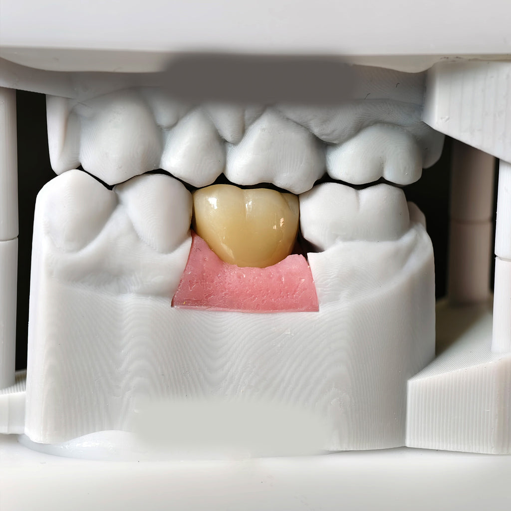 Zirconia Crown With Screw Retained