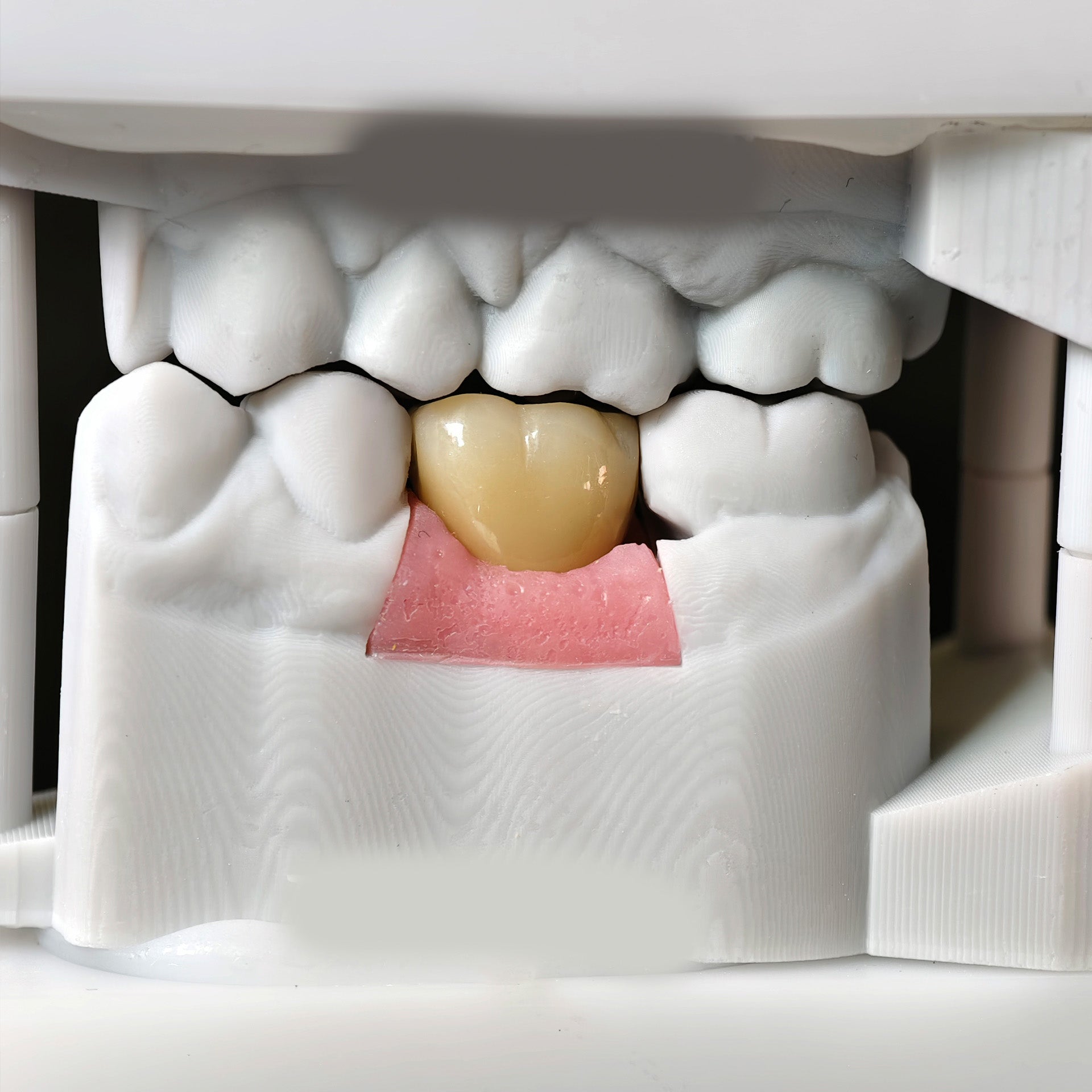 Zirconia Crown With Screw Retained