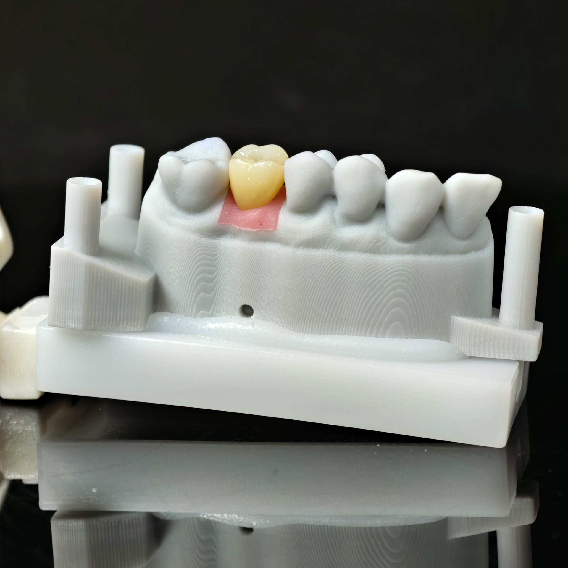 Zirconia Crown With Screw Retained