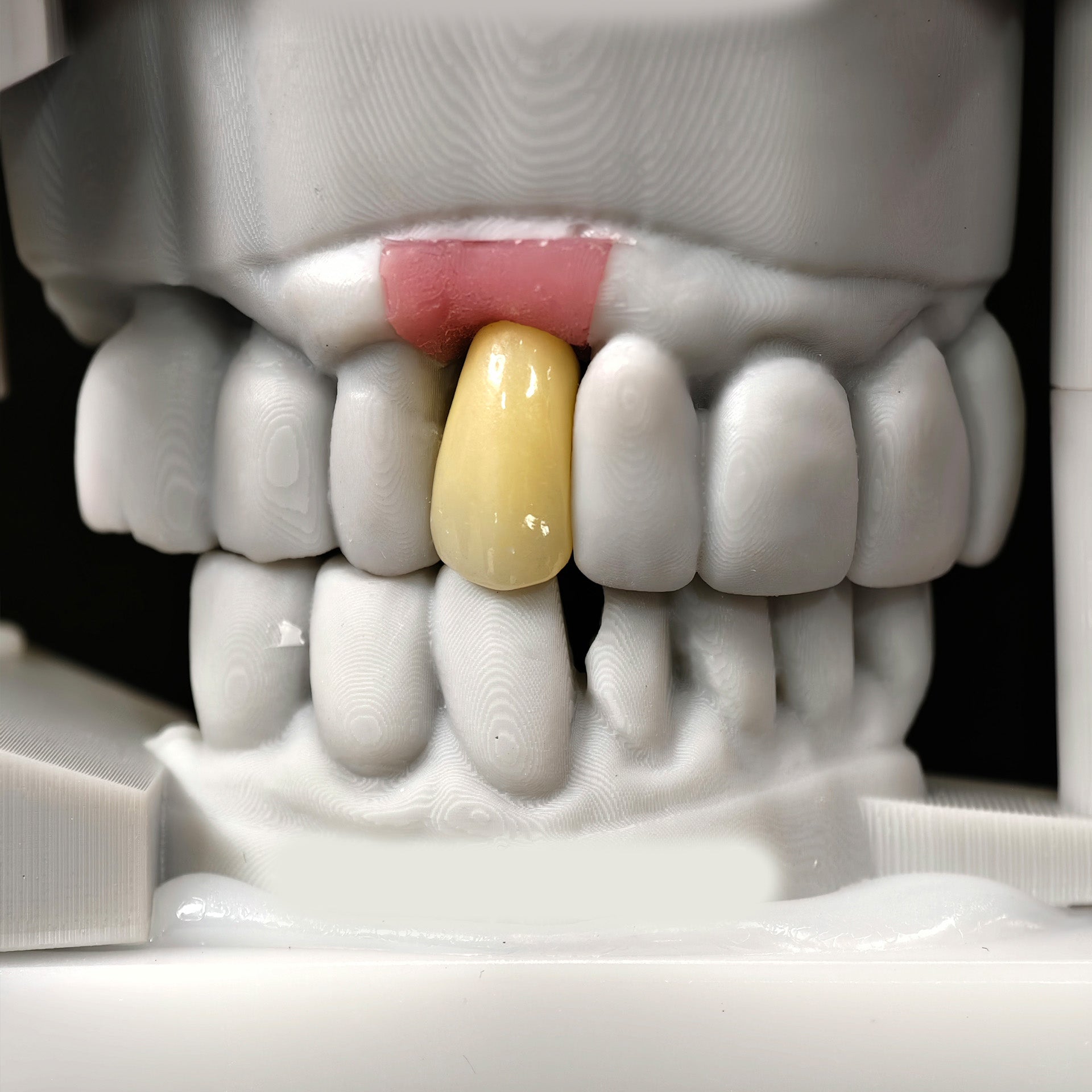 Zirconia Crown With Screw Retained