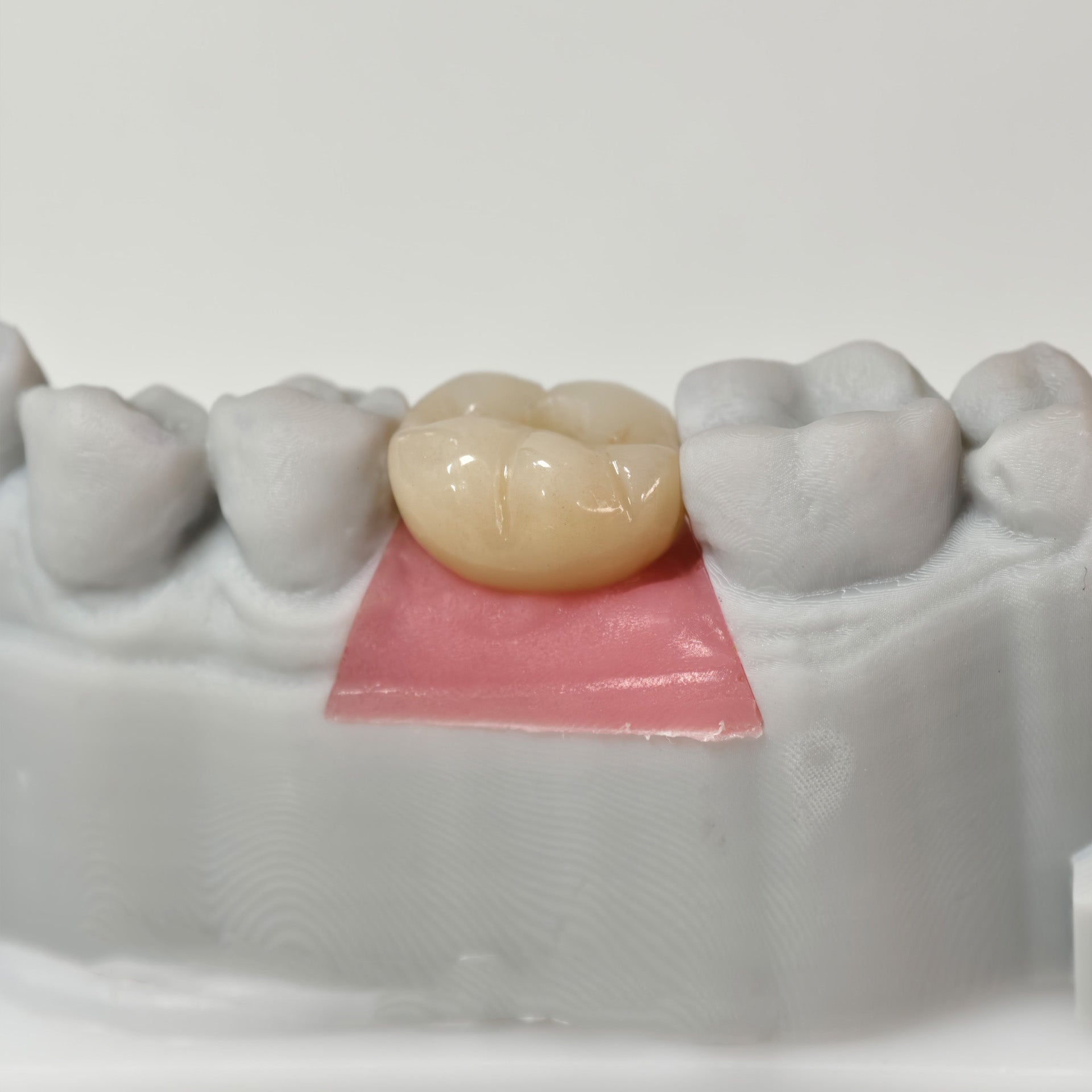 Zirconia Crown With Screw Retained