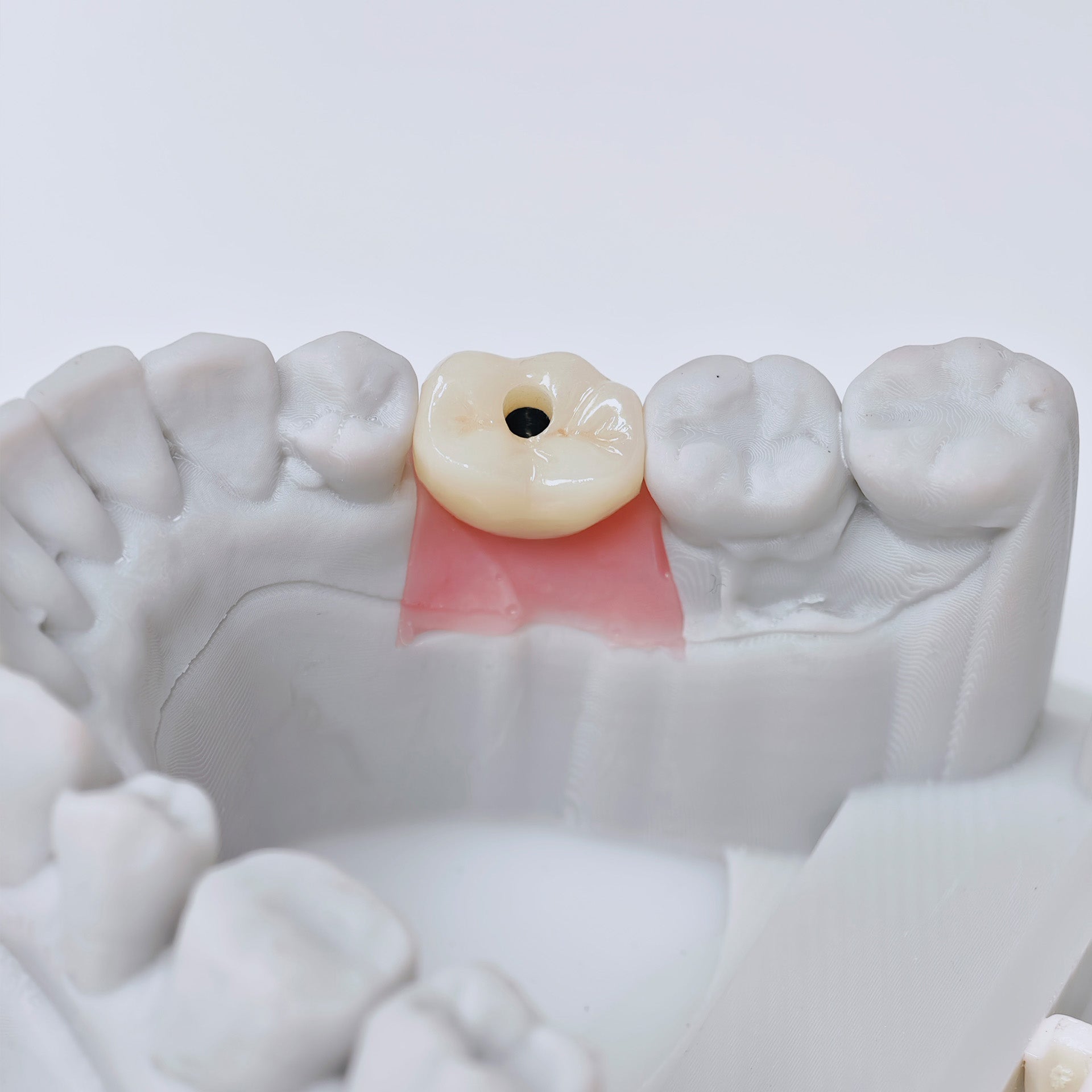 Zirconia Crown With Screw Retained