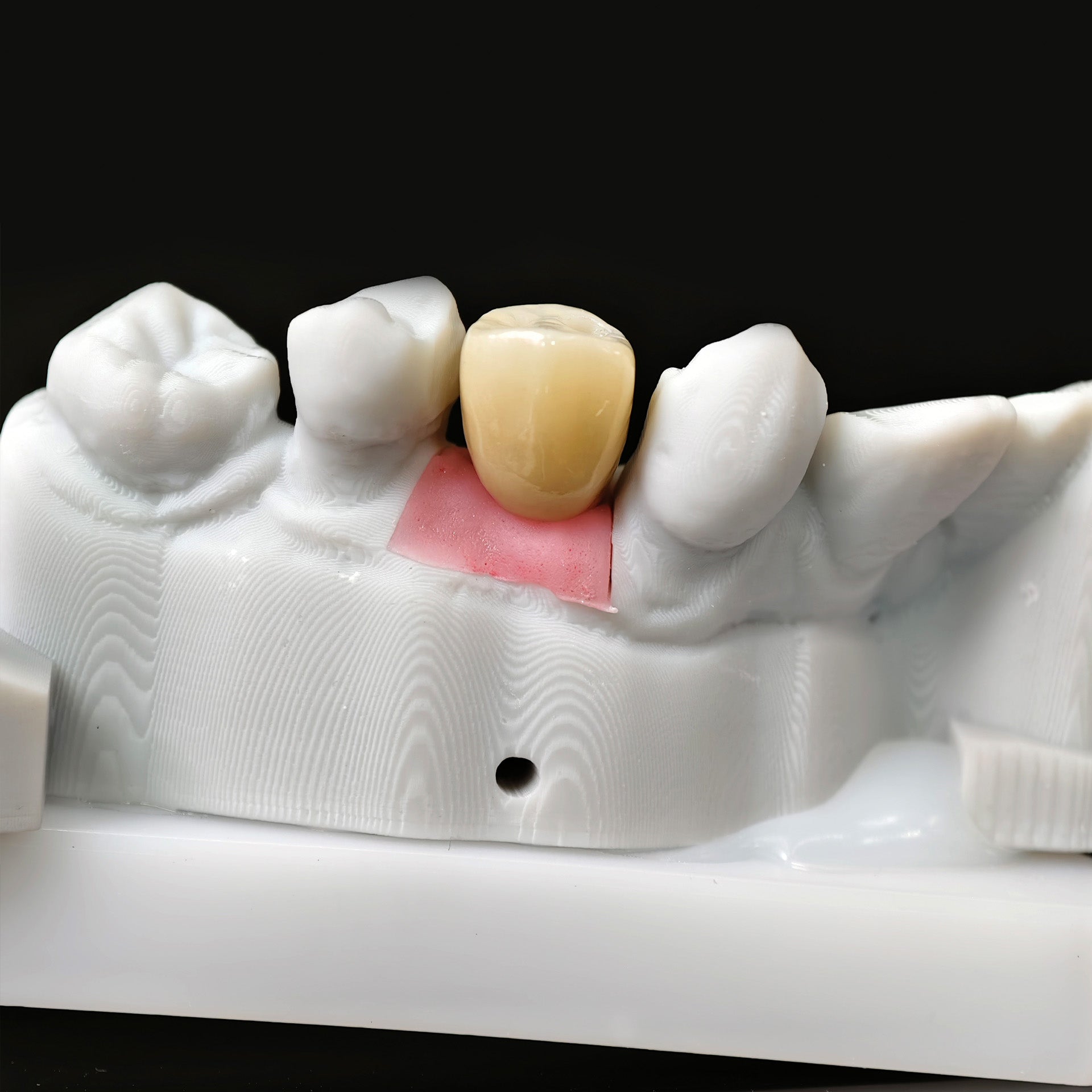 Zirconia Crown With Screw Retained